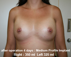 plastic-surgery-breast-augmentation
